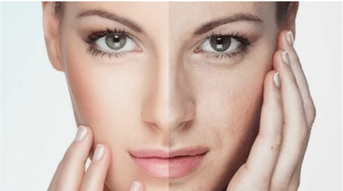 Rajeunissement efficace du visage